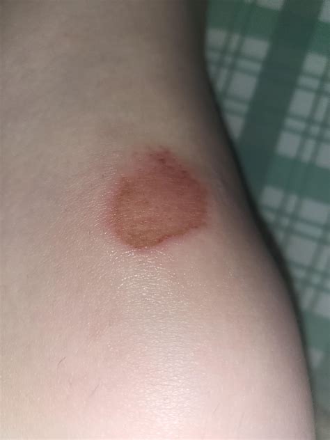 Alocane for friction burn? : r/woundcare