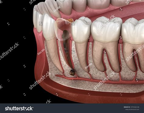 Cyst Tooth Images: Browse 537 Stock Photos & Vectors Free Download with Trial | Shutterstock