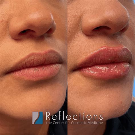 Lip Filler Before and After Photos and Results - the daily glimmer