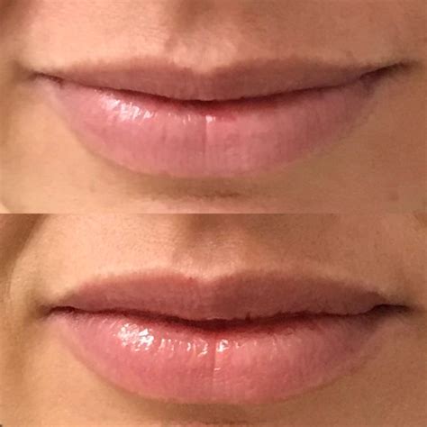 BOTOX Lip Flip Overview: Everything You Want to Know