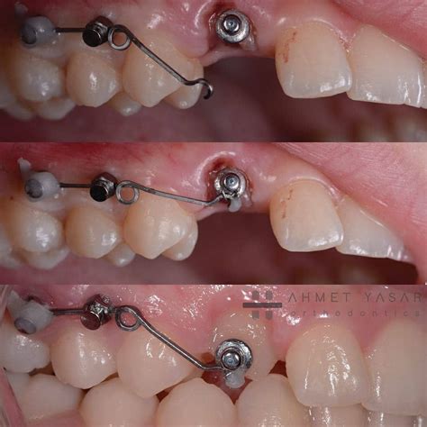 Braces Brackets In Spanish at Scott Morris blog