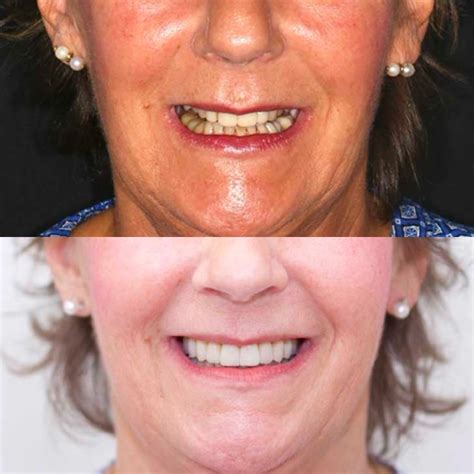 Protesi Dentali - Clinica Cicero