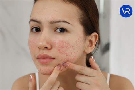 Fungal Acne On Neck And Chest at Terry Camacho blog