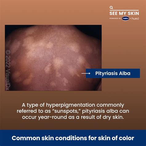 Pityriasis Alba