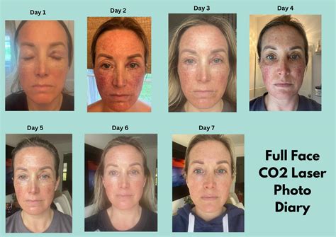 CO2 Laser Resurfacing in Westchester, NY | CO2 Laser Skin Resurfacing