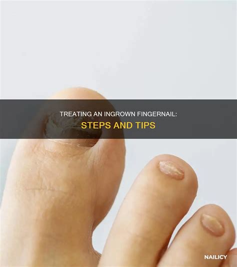 Treating An Ingrown Fingernail: Steps And Tips | Nailicy