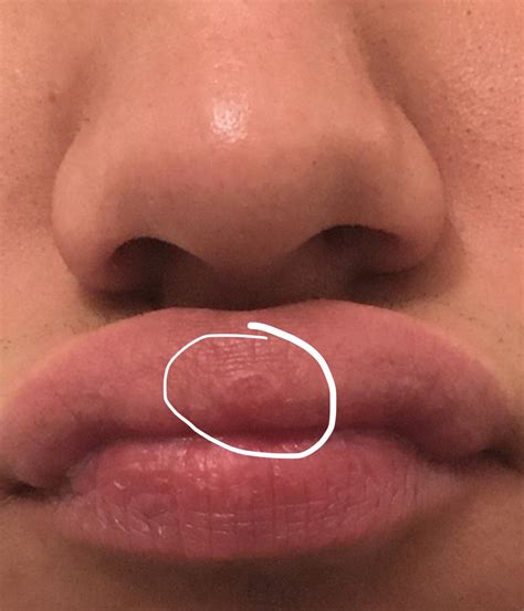 Grouped up Fordyce Spots or something else? I just noticed this cleaning my nose. : r/Dermatology