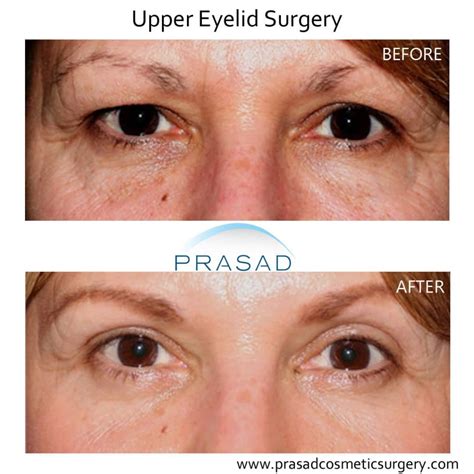 How Hooded Eye Surgery Scars are Minimized | Dr. Prasad Blog