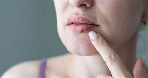 How To Recognize Cold Sores