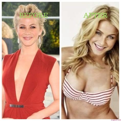 Julianne Hough Plastic Surgery Face