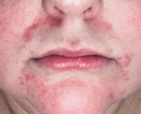 Perioral Dermatitis Colloidal Silver at Gail Carroll blog