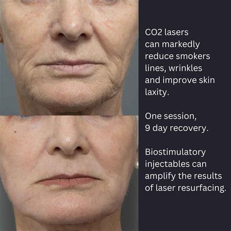 Best CO2 Laser Resurfacing Near Me | Dr Davin Lim
