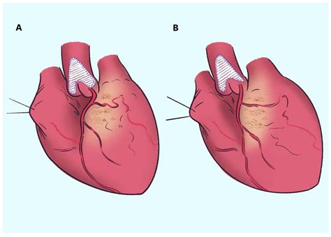Clinical Results of a Modified Doty’s Technique for Supravalvular ...