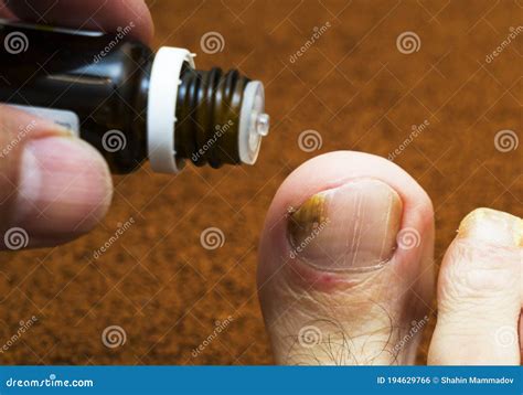 Toe and Nail Fungus. Dermatologist. the Doctor Treats the Patient S Feet. Stock Photo - Image of ...