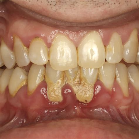 Receding Gums Surgery