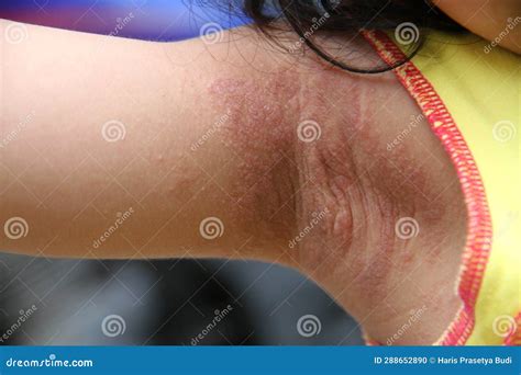 Close Up Photo of a Small Child& X27;s Armpit with Allergies. Skin Allergy, Itching and Redness ...