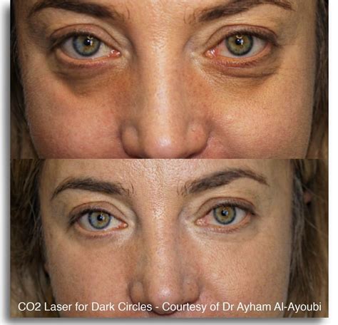 Dark Circles Under Eyes Laser Treatment at Cheryl Talley blog