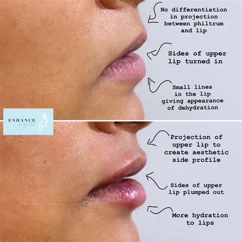 Lip fillers are lip fillers safe – Artofit