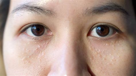 Syringoma: Symptoms and Removal Treatment Options in Singapore
