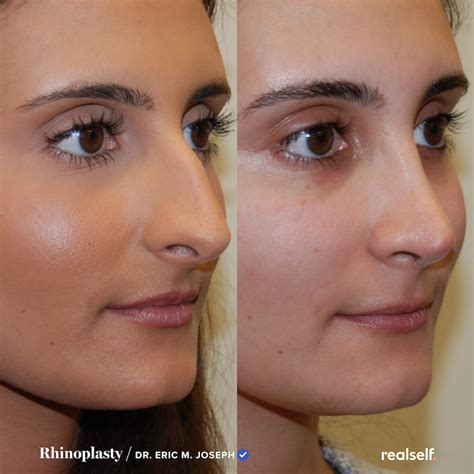 Best 12 8 Rhinoplasty Recovery Rules You Should Always Follow After ...