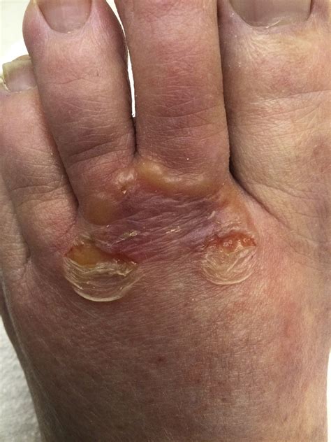 Foot Fungal Infection Blisters
