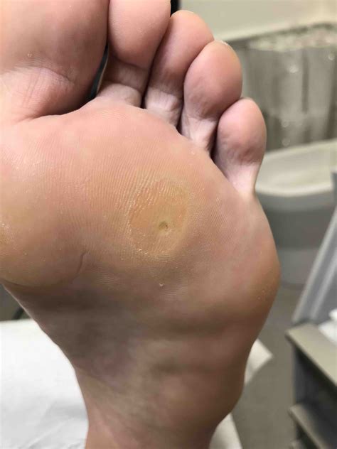 Infected Corn On Bottom Of Foot Clearance | emergencydentistry.com