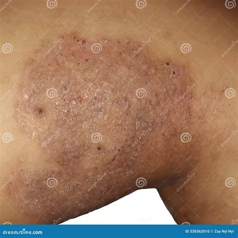 Dermatophytosis, Also Known As Tinea And Ringworm, A Fungal Infection Of The Skin Stock Photo ...