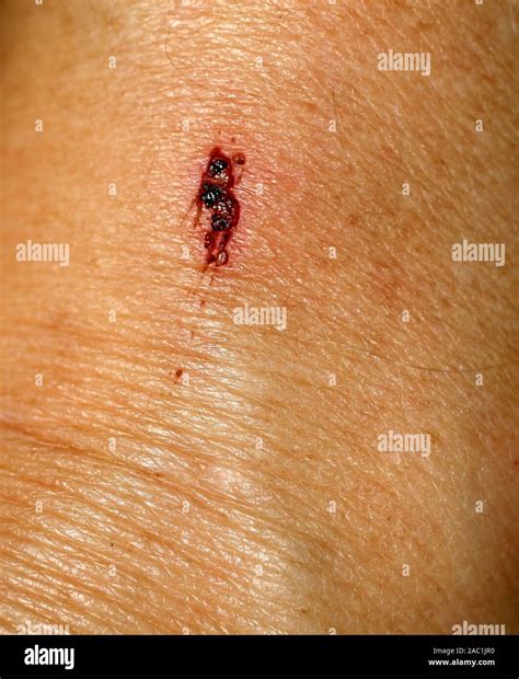 Scratch, abrasion, cut on the skin. wound Stock Photo - Alamy
