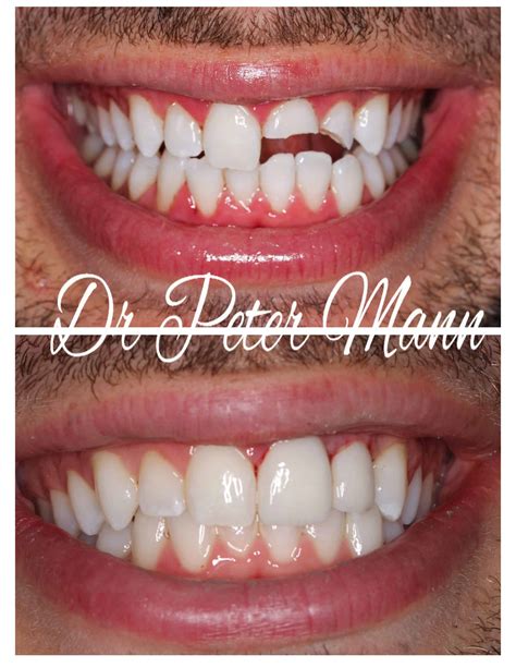 Front Tooth Crown Before And After 1 Porcelain Crown On Upper Front