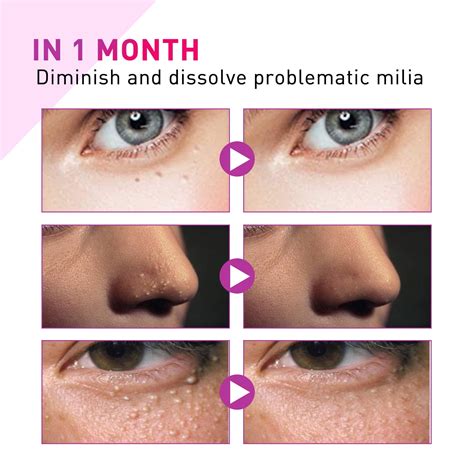 Best Milia Removal Videos at Charles Mattingly blog