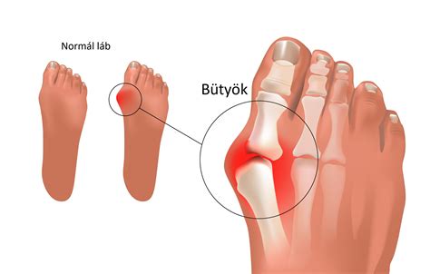Bütyök kezelése Safe Laser készülékkel - Házilag lehetséges?