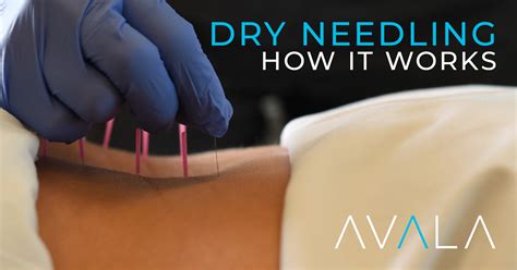 Dry Needling: How It Works - AVALA