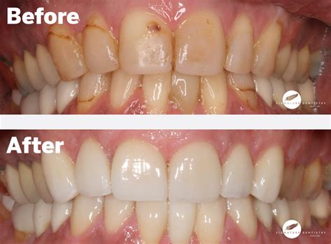 Veneers Before and After In Melbourne By Dr Kasen