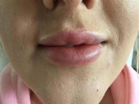 The Transformation with Lip Fillers-Before and After 1ml