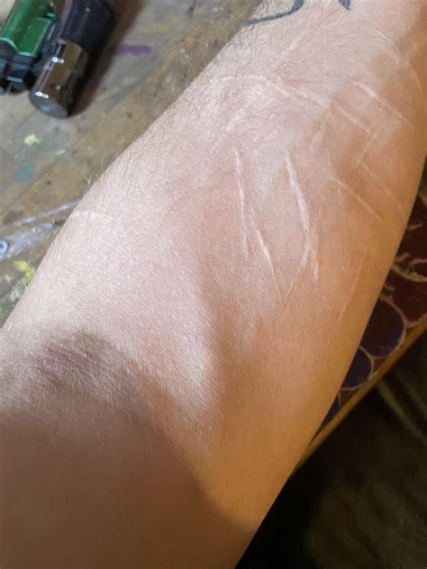 The median cubital vein : r/MethWithoutCommunism