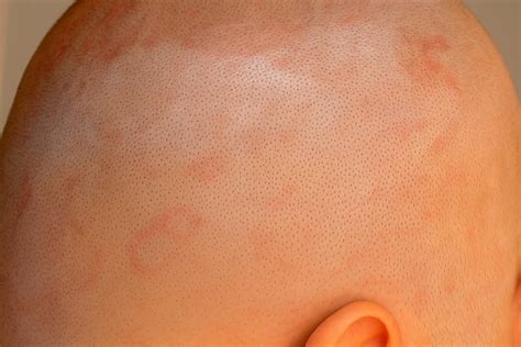 Hongos Cuero Cabelludo: Síntomas y Tratamientos Efectivos