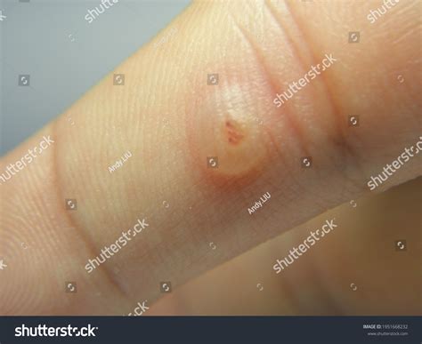 Viral Warts Cryotherapy Blisters On First Stock Photo (Edit Now) 1951668232
