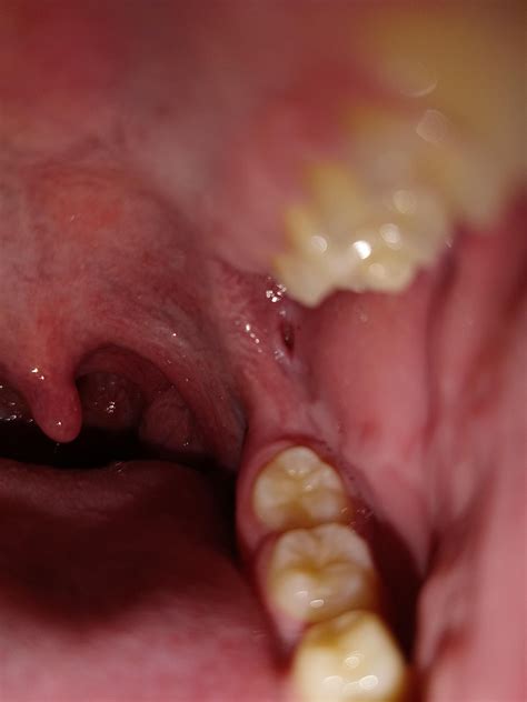 Right humerus pointing anterior and inferior, with right shoulder impingement : r/DiagnoseMe