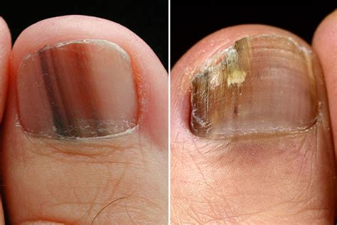 Early Toenail Fungus