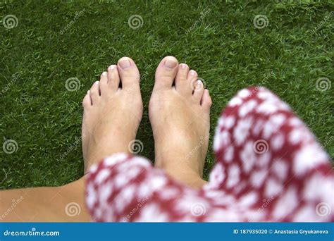 Top View of Female Legs with Fused Middle Toes on Green Grass Background. Webbed Toes Genetic ...