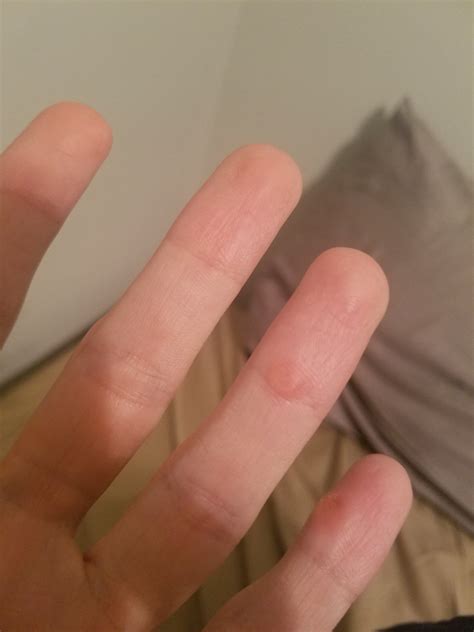 Bump On Finger