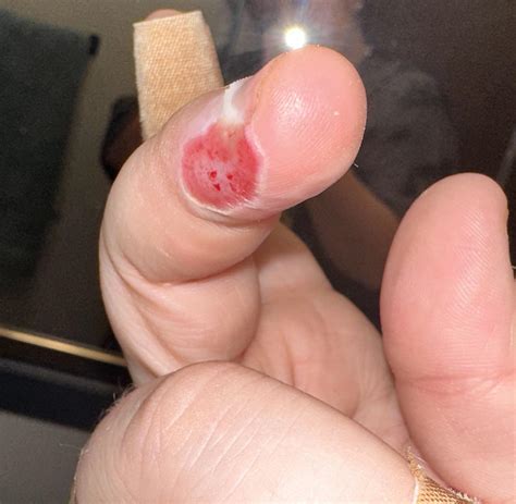 Friction Burn Care : r/woundcare