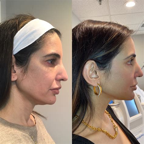 Thread Lift Before & After Photos | Gambhir Cosmetic Medicine