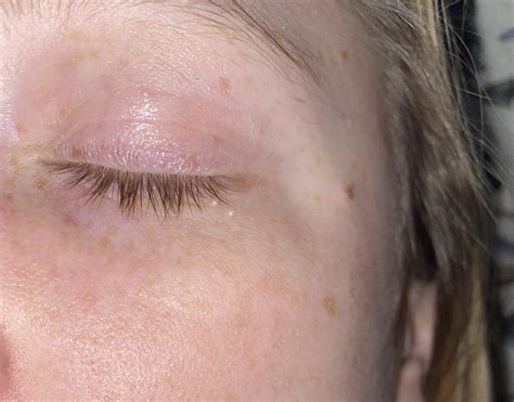 White Bump On Eyelid