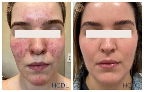 Excel V Laser For Acne Scars at Paul Bennette blog