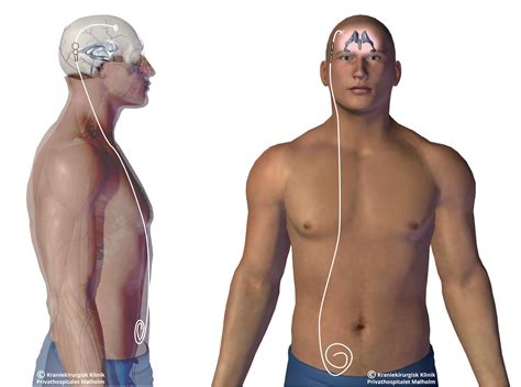 Diagnosing and treatment of normal pressure hydrocephalus