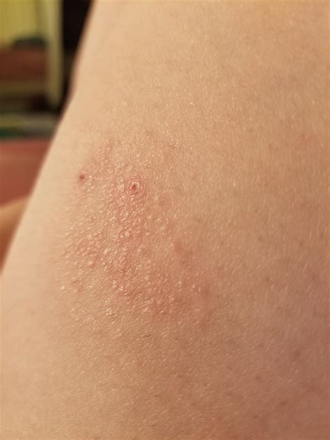 Itchy Rash On Inner Thigh at Don Walker blog
