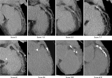Non-invasive screening for coronary artery disease: calcium scoring | Heart