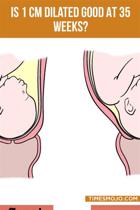 Is 1 cm dilated good at 35 weeks? - TimesMojo