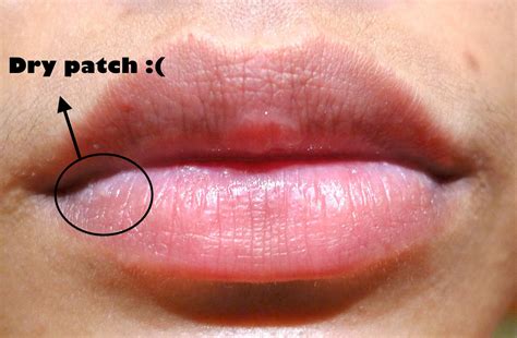 Why Do I Have A Dry Patch On My Upper Lip at Sandra Willis blog